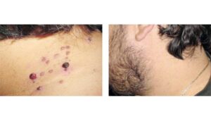 como eliminar las manchas en la piel rápidamente