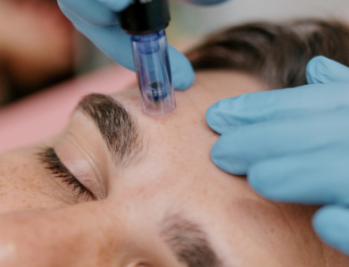 Microneedling: qué es, cómo funciona y para qué se utiliza en estética