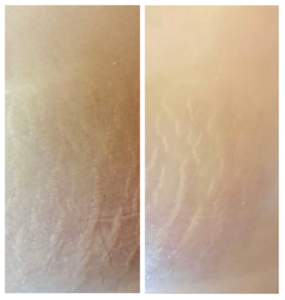 microneedling-antes-y-despues