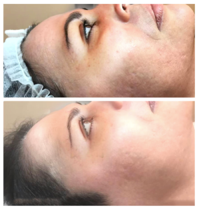 microneedling-antesdespues