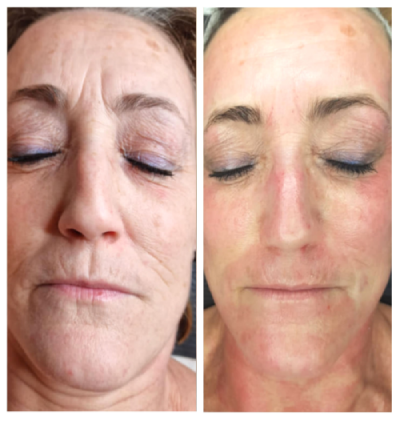 microneedling-facial-antes-y-despues